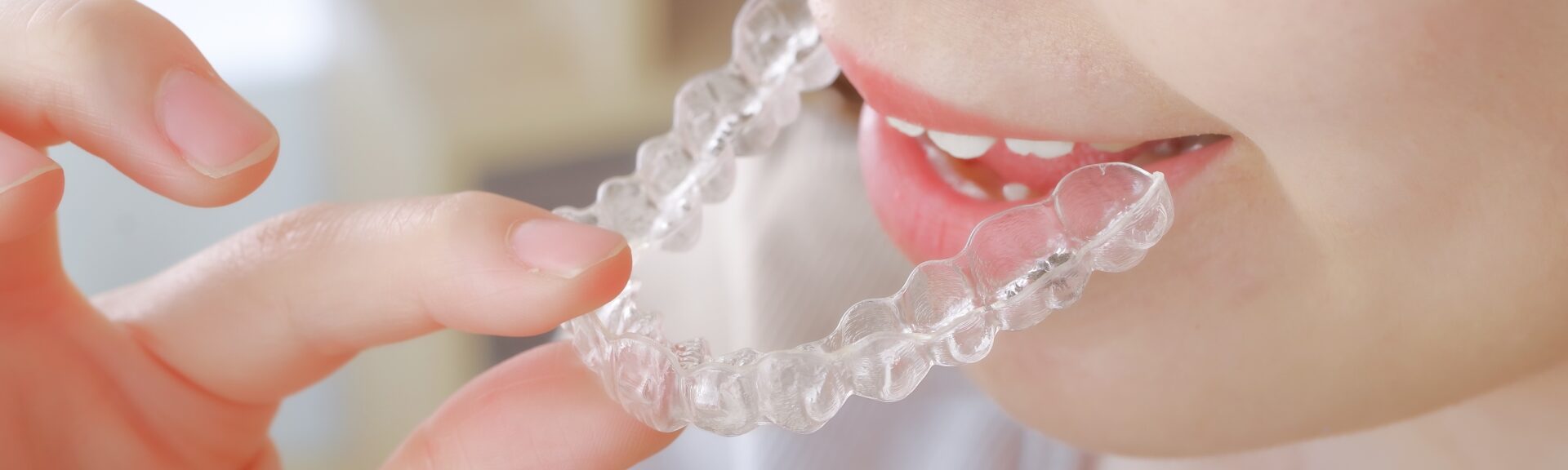 非抜歯矯正とは｜歯を抜かない選択