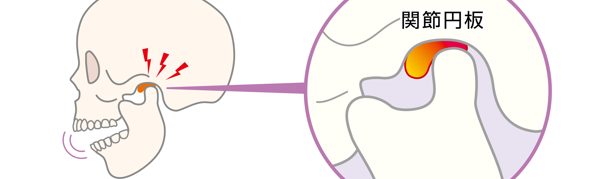 顎関節症と歯列矯正｜噛み合わせの関係